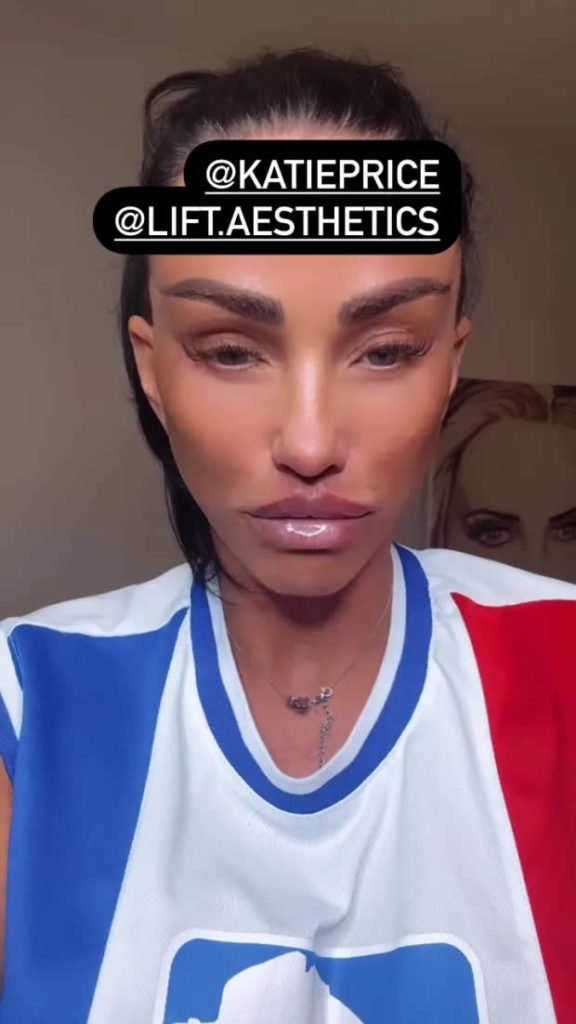 Katie Price butterfly lips