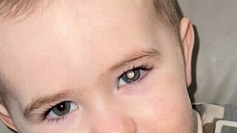 Parents Spot White Glow in Toddler’s Eye – Devastating Cancer Diagnosis Follows